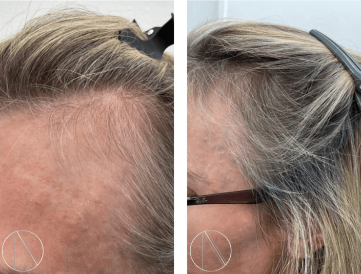 Best-Hair-Loss-Treatments-for-Receding-Hairline-in-Women
