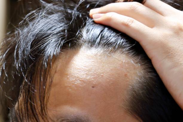 This is the hairline of a Japanese man's forehead.