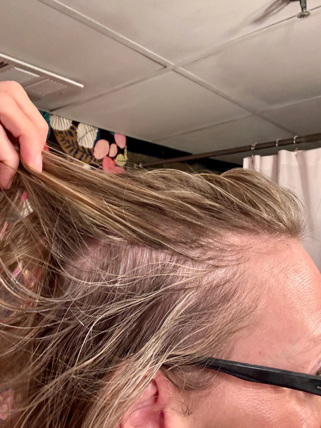 7-month-progress-on-oral-and-topical-minoxidil-v0-ff9efdfbxz1f1