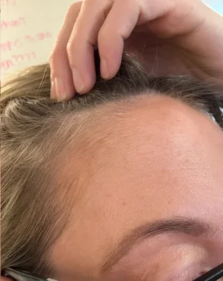 7-month-progress-on-oral-and-topical-minoxidil-v0-zx5ofrlgxz1f1